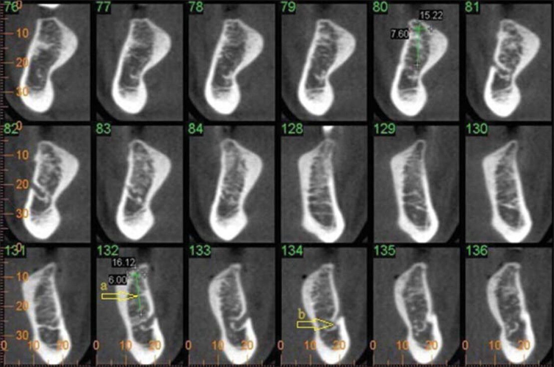 40-year-old male with mandibular posterior region. CBCT of mandibular posterior region for the evaluation of implant placement (a) shows the implant size (arrow) using the available bone and (b) points out the cross section of the inferior alveolar nerve (arrow).